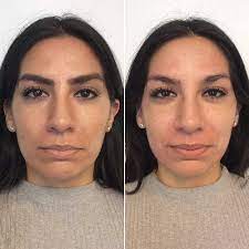 Microcurrent non surgical facelift before and after courtesy of @therealskinsaviour on instagram